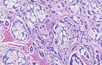 A B Obr. 1. A. Typická histologická struktura AdCC s převahou kribriformních a pseudocystických struktur, HE barvení, zvětšení 200x. B. Imunohistochemická exprese MYB s nukleární pozitivitou, zvětšení 200x.