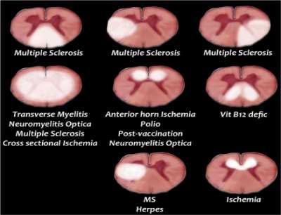 Diferenciální diagnostika myelopatií