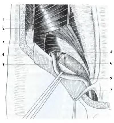 Falx inguinalis = Tendo conjunctivus obvykle přítomný jako svalový oblouk jako vazivový oblouk přítomný v