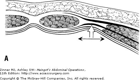 Hernia