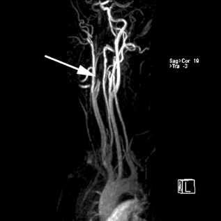 ischemického iktu v povodí disekcí poškozené arterie včasná diagnostika