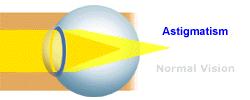 Asférické ametropie (astigmatismus) Astigmatismus vzniká tehdy, jestliže rohovka nebo čočka mají různé zakřivení v různých