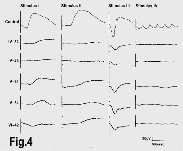 Elektroretinografie (ERG) Elektroretinografie Je vyšetření, při kterém se měří elektrická odpověď světločivých