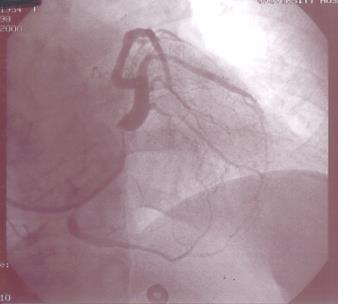 Resynchronizačná liečba Right Atrial