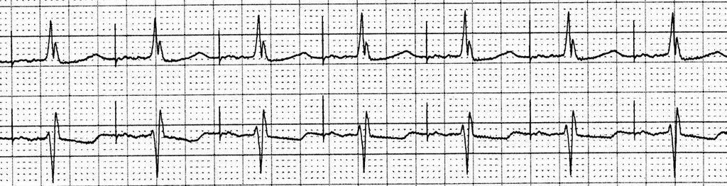 syndróm (únava, dýchavica, závraty) mnohokrát stačí - najmä starší a málo aktívni pacienti s intermitentnými bradykardiami