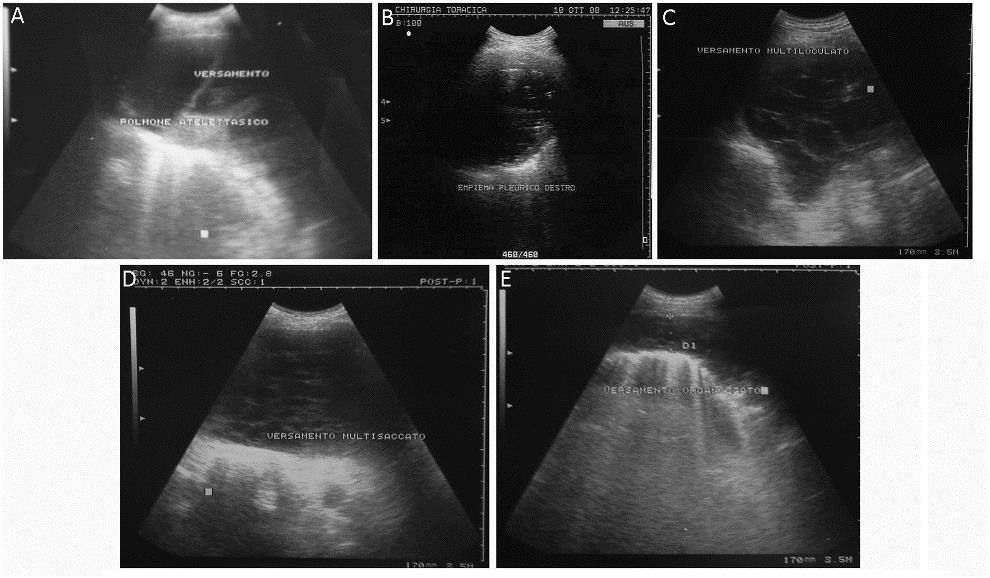 Ultrazvuková klasifikace empyemu Uniportal thoracoscopic decortication for pleural empyema and the role of