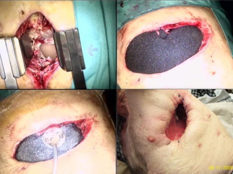 VAC Sziklavari Z, Ried M, Neu R et al; Mini-open vacuum-assisted closure therapy with instillation for