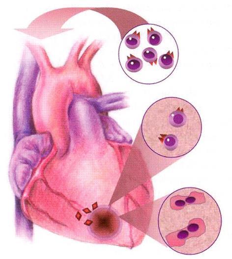 Hypotetické možnosti regenerace srdečního svalu Progenitory kmenové buňky z krevního