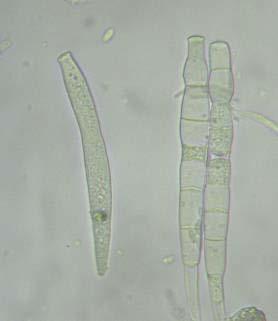 Hnědá stonková hniloba a spála květů kmínu (Mycocentrospora acerina) Symptomy: