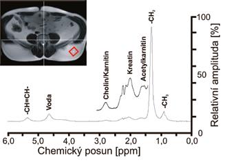Ces Radiol 207; 7(4): 305 3 v buňce a septu. Teoreticky byl tento rozdíl chemických posunů vypočten podle modelu bulk magnetic susceptibility a činí 0,2 ppm.
