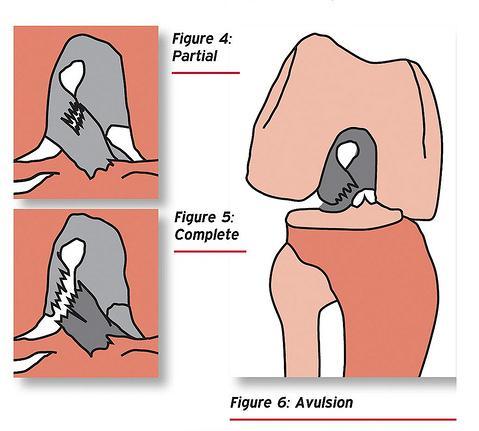rychlé progrese [27]. Následkem poškození tohoto vazu dochází k rychlému rozvoji instability kolenního kloubu a může se velmi časně vyvíjet osteoartróza [15].