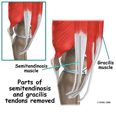 Obr. č. 8 - Místa odběru šlach hamstrigů (Dostupné z: [online] http://www.moveo.ca/injuries- Conditions/Knee/Surgery/Hamstring-Tendon-Graft-Reconstruction-of-the-ACL/a~352/article.html [cit.