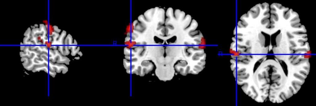Obr. 2.7: Zobrazení centra bolesti v obličeji pomocí fmri pro nastavení magnetické rezonance 2.3.