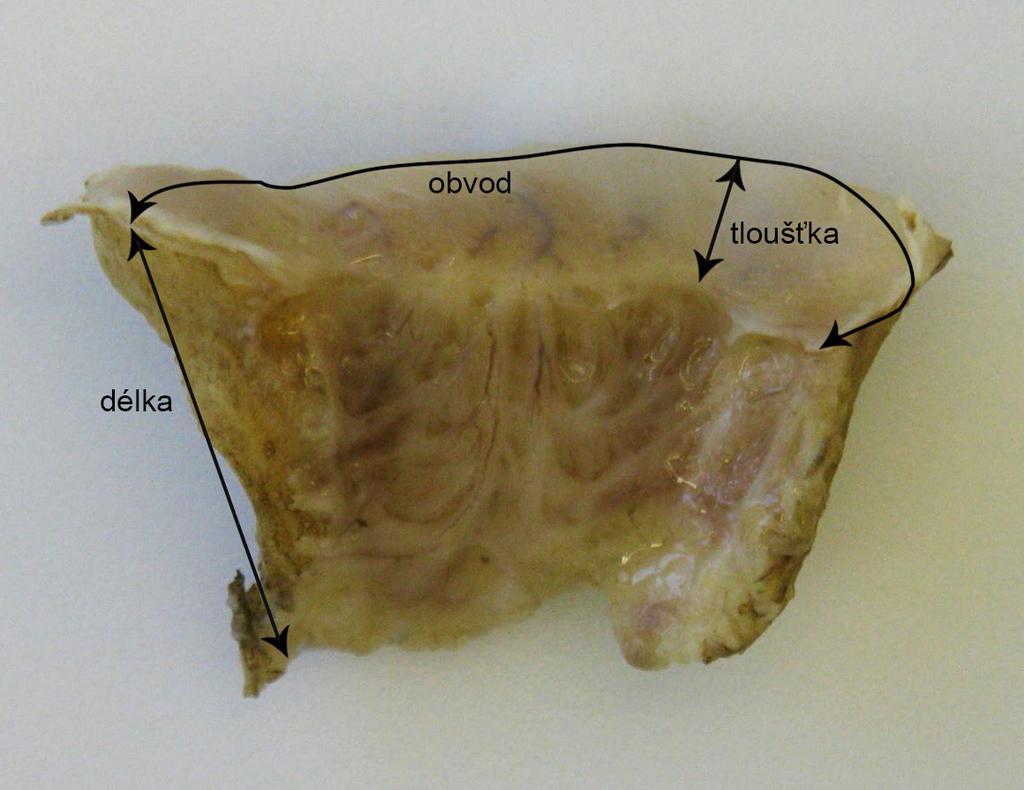 Obrázek 1: Terminologie rozměrů excizních vzorků ( loop excize; konizace skalpelem) podle International Federation for Cervical Pathology and Colposcopy (rozstřižený (1A) a nerozstřižený (1B) vzorek)