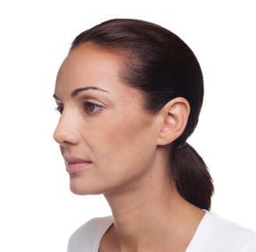 Radiesse je to správné řešení mezi krémem a plastickou chirurgií. Používá se ke stimulaci tvorby kolagenu, k doplnění chybějícího objemu a ke zpevnění kontur tváře.