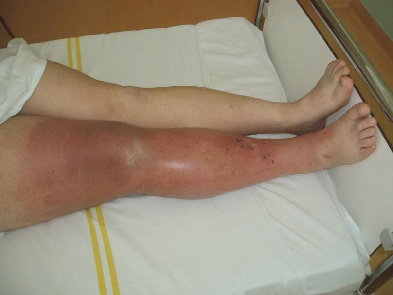 REGIONÁLNÍ HYPERTERMICKÁ PERFÚZE KONČETINY S MELFALANEM U MALIGNÍHO MELANOMU Inoperabilní nález na končetinách, intransitní metastázy bez celkové diseminace nemoci Končetina napojena na
