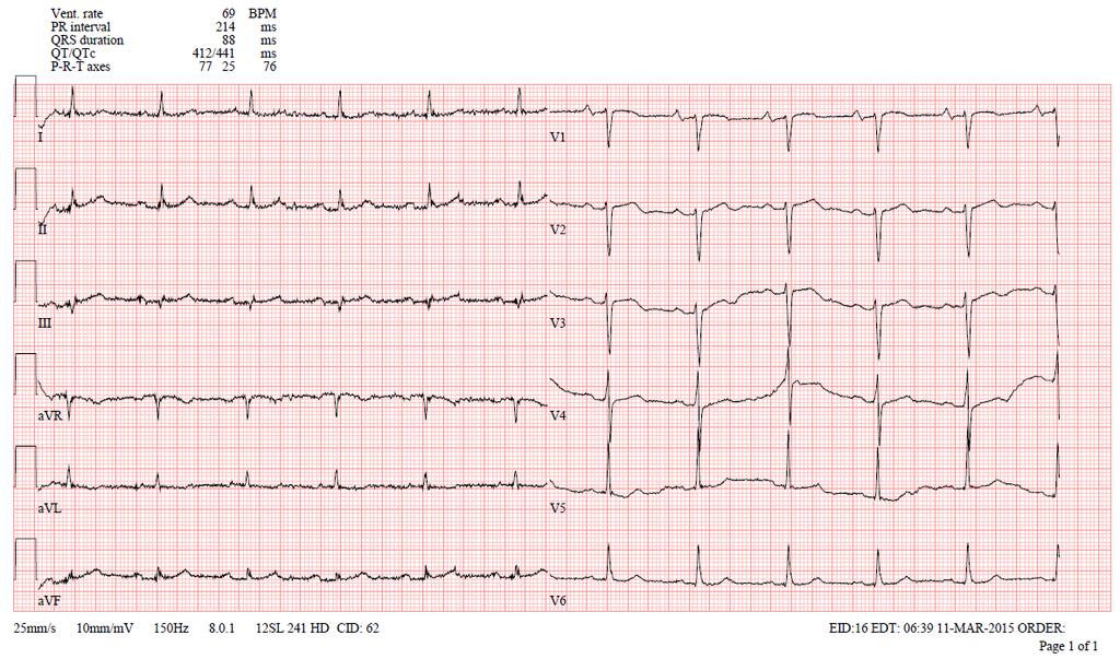 EKG při