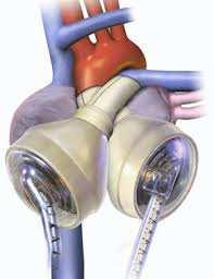 devices: Pasivní Intra-aortální balonková kontrapulzace (IABK) Ostatní pasivní podpůrná