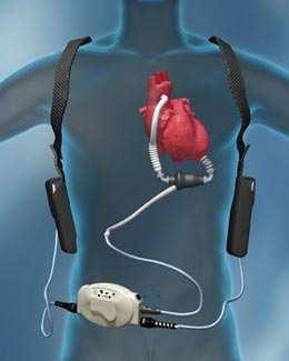 HeartMate II LVAD Implantabilní systém zaváděný