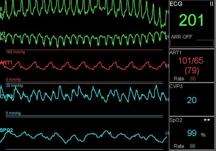 Ventricular assist devices (VAD) Klasifikace VAD: Lokalizace krevní pumpy extrakorporální x implantabilní