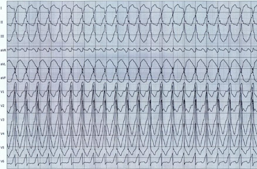 EKG 3C při