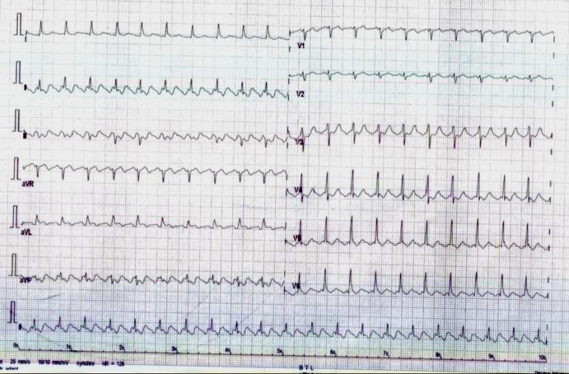 EKG 5