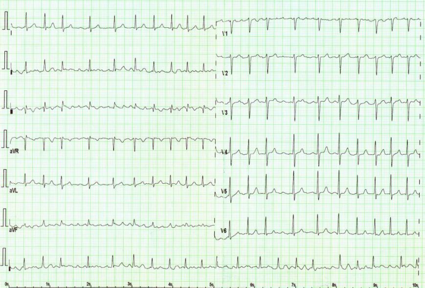 EKG 6