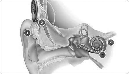 3.2 Kochleární implantát Pouze v případě osob s lehkými stupni sluchového postižení (lehkou nedoslýchavostí) dokážou sluchadla zesilovat okolní zvuky do takové míry, že nejsou při vnímání mluvené