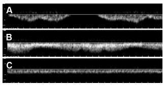 Tok ve VFC + Valsalva Kvalitativně Jako samostatný test diagnosticky nepřínosné Respirace + Valsalva Sens. Spec.