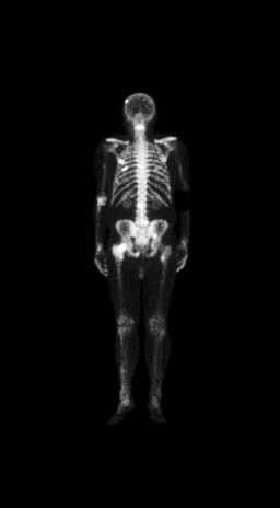 Bone scintigraphy with the presence of metastase (skull, left os parietale, sternum, vertebrae C3, Th7, L2, right ilium, os pubis, left femur) Obr. 5.