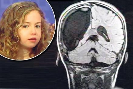 Reparační neuroplasticita příklad Cameron Mott Devítiletá dívka trpící vzácným autoimunitním onemocnění - Rasmussenovým syndromem, který postihuje jednu hemisféru a projevuje se velmi častými