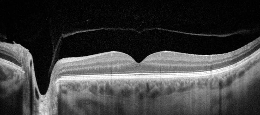 Nový software REVO NX splňuje požadavky každodenní rutiny na moderním očním pracovišti. Nový angiografický modul rozšiřuje přesnost diagnostiky s minimální únavou pacienta.