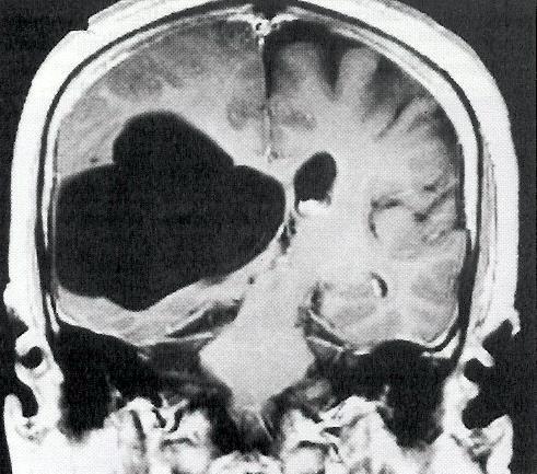 CT MRI - i k vizualizaci cyst lokalizovaných v mozk.