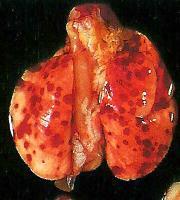 PREPATENTNÍ ASKARIÓZA: SYMPTOMATIKA A PATOGENEZE EXTRAINTESTINÁLNÍ FÁZE PLICNÍ FÁZE (askariová pneumonie) poškození kapilár a plicních alveol