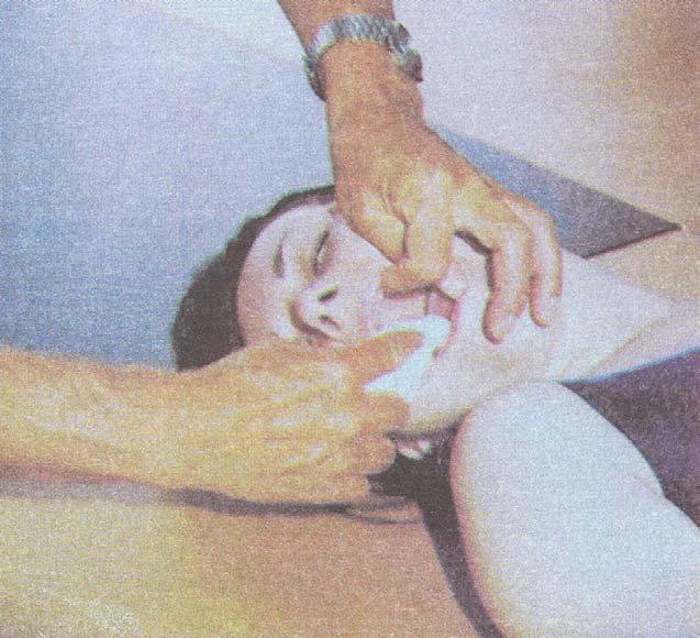 Umelé dýchanie (metóda z pľúc do pľúc) - postup 1) záchranca rýchlo odstráni prekážky z ústnej dutiny, ktoré by mohli brániť umelému dýchaniu (hrubé nečistoty, zvratky, uvoľnená zubná protéza).