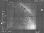 ICHS - angina pectoris Diagnostika - pokračování: Echokardiografie: klidové, zátěžové; hodnocení poruchy