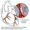 Ischemická choroba srdeční Příčina: organická - ateroskleróza (95%), trombus, embolie, arteritida, atd.