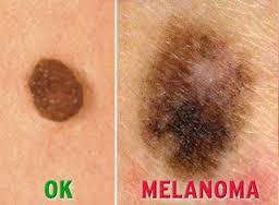 Rakovina kůže Nejzhoubnější je maligní melanom rakovina