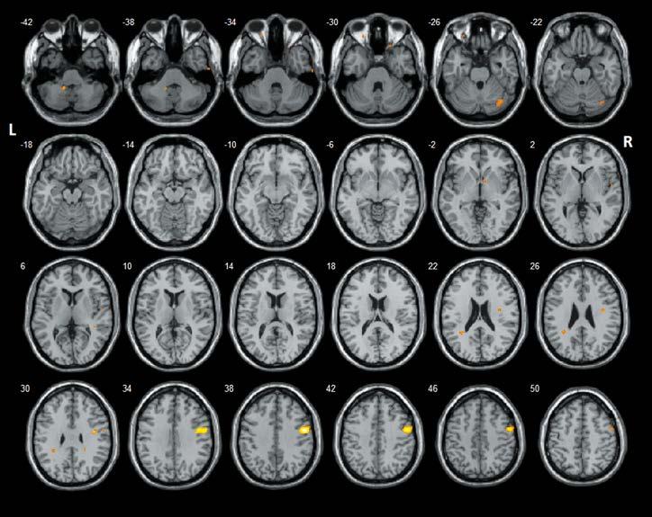 rozvoj epileptické encefalopatie, charakterizovaný stagnací/regresem behaviorálně-mentálních dovedností a kontinuální či téměř kontinuální EEG abnormitou. resp.
