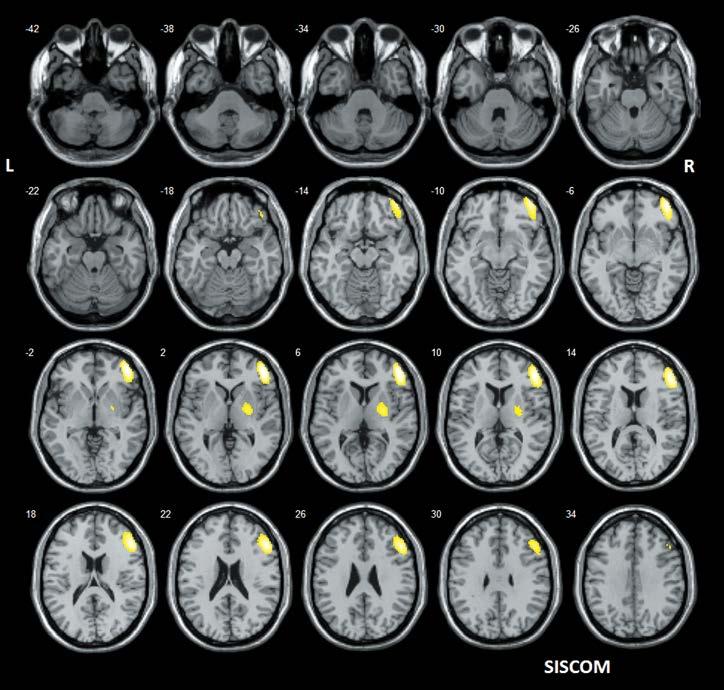 Obr. 7. SISCOM (koregistrace subtrakčního iktálního SPECT s MRI) lokalizuje pravostranně premotoricky Obr. 8.