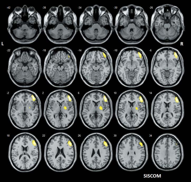 Obr. 7. SISCOM (koregistrace subtrakčního iktálního SPECT s MRI) lokalizuje pravostranně premotoricky Obr. 8.