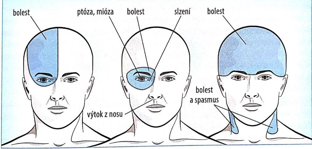 2.1 Primární bolesti hlavy Nejedná se o projev žádného dalšího onemocnění. Nejsou přítomny žádné strukturální či organické postižení interkraniálně ani extrakraniálně.