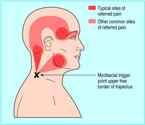 MTrPS v horní části m. trapezius jsou častým jevem u pacientů s tenzními bolestmi hlavy.