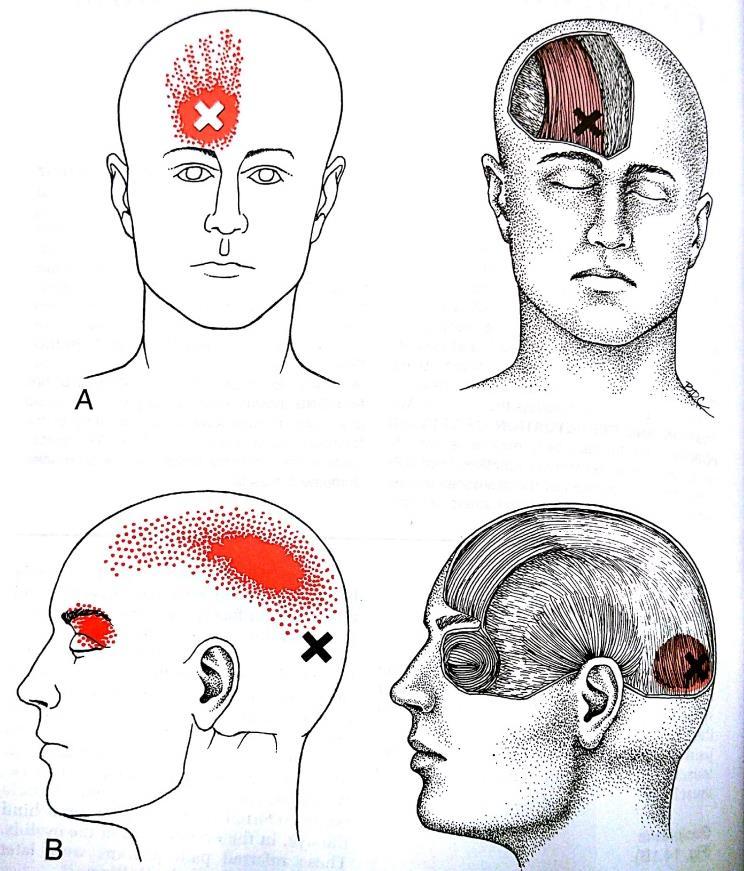 Příloha 15 Zóna přenesené bolesti TrPs m. temporalis, ATrP1-3 se vyskytují v oblasti musculocutánního spojení (A, B, C), CTrP4 centrální TrP m.