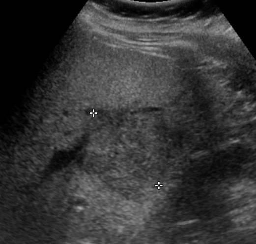 Centrální jizva (do 3 cm 35%, nad 3 cm 65%) Hypo/isoechogenní,