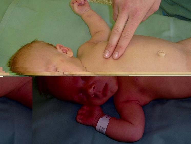 děti do 1 roku se masírují: dvěma prsty