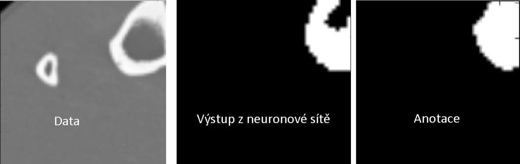 Trénování na podobrazech Obrázek 35 podobraz získaný z 650. vrstvy testovacího CT skenu.