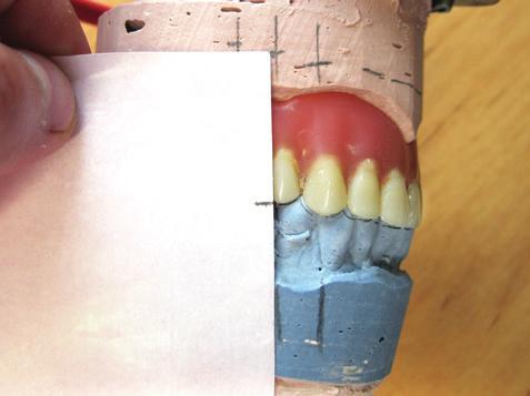 Na alveolární hřeben naneseme vosk, do kterého budeme upevňovat zuby.