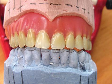 postavení zubů ve staré zubní náhradě (obr. 10).