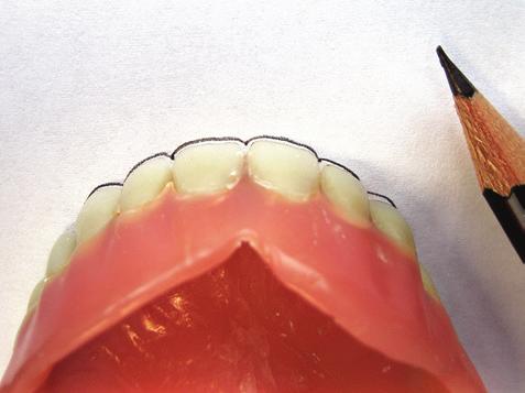 Velmi účelná je tato pomůcka také při stavbě rotovaných zubů a následné kontrole správnosti postavení zubů (obr. 11).